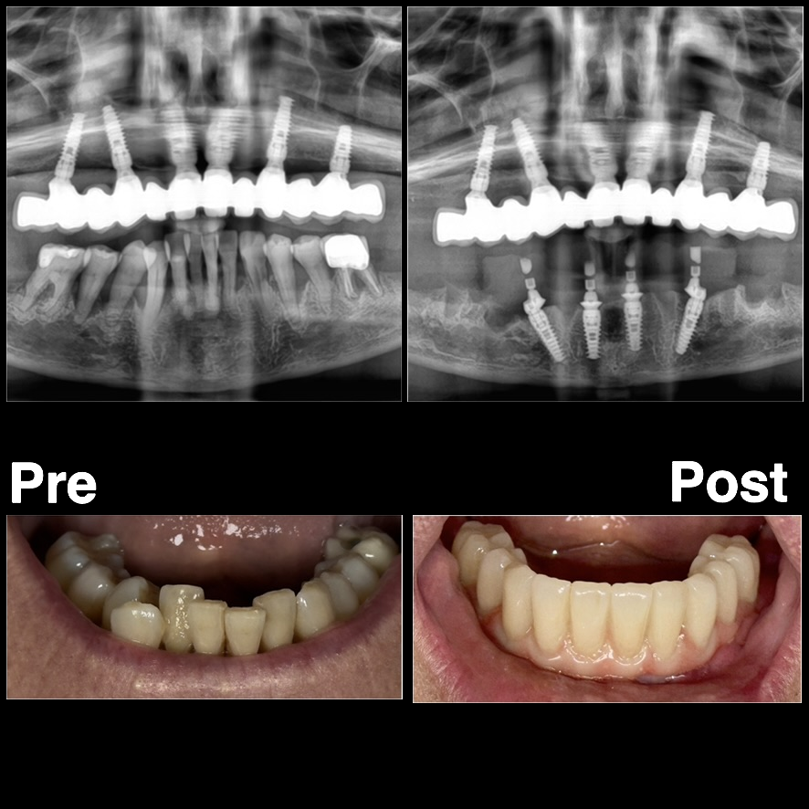 Riabilitazione implantare delle due arcate, confronto radiografico e clinico prima e dopo