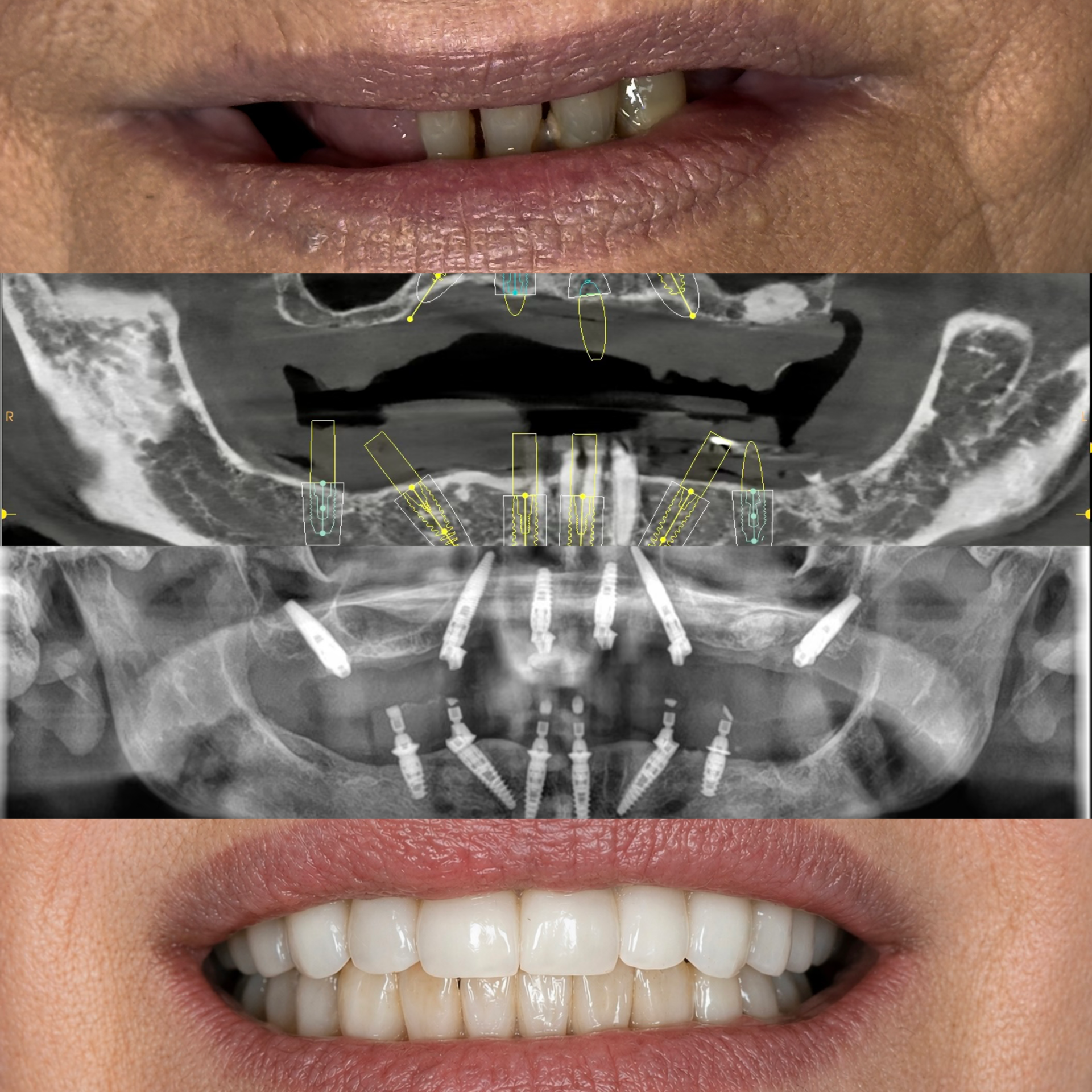 Riabilitazione implantare complessa delle due arcate